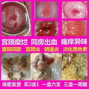 妇科炎症凝胶治疗宫颈糜烂重中度肥大囊肿霉菌性阴道炎盆腔炎用药
