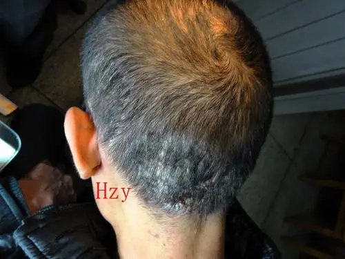 头皮瘙痒有厚积的鳞屑