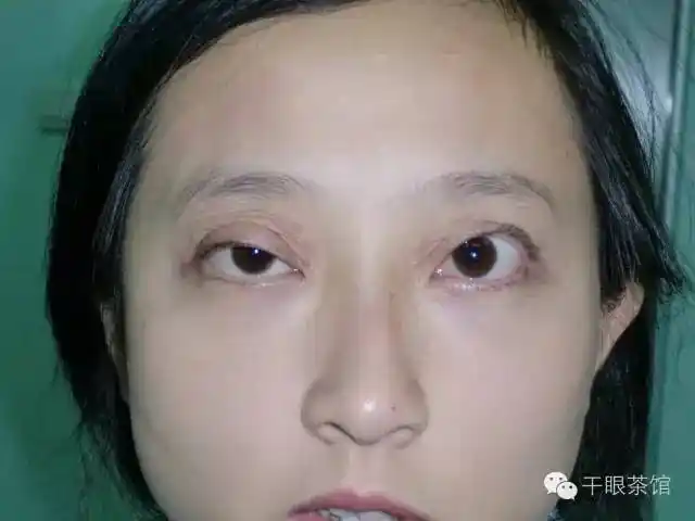 眼皮松弛下垂原因很多_眼睑