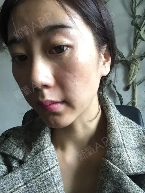 吸脂后皮肤松弛_圈子-新氧美容整形