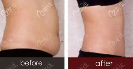 北韩韩美做腰腹吸脂前后效果对比