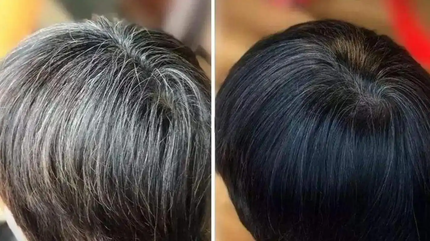 后脑勺白发提示你肾气不足了;  头顶长白发这是你的气血虚了;  赁鬓