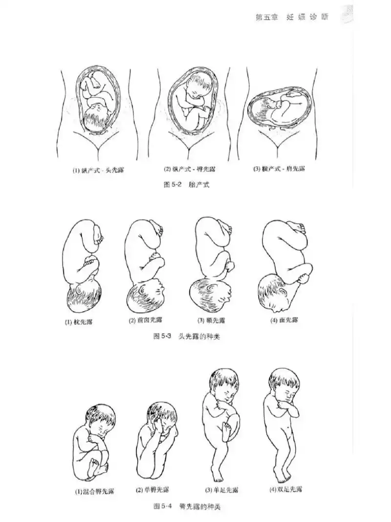胎儿的头位一般分为三类:头位,臀位,横位 头位: 胎儿头部朝下,可顺利