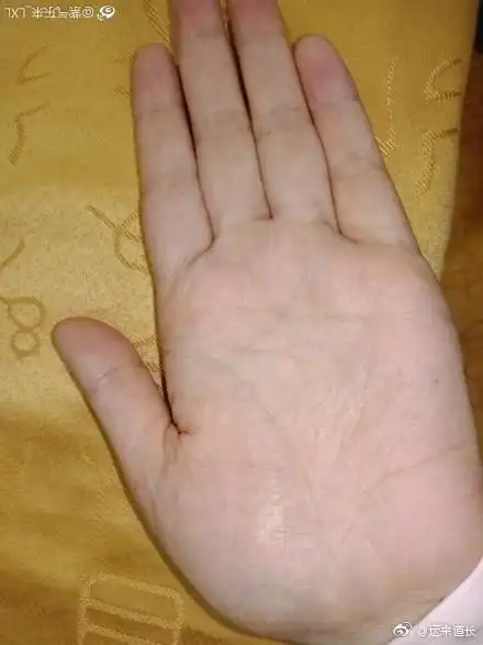 双手月丘都有健康纹,且延伸与生命线相交,生命线呈锁链状,这些都表示