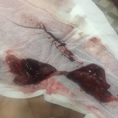 出血2天了,去医院开了药打了针,每到晚上血量增加,很平时月经量一样