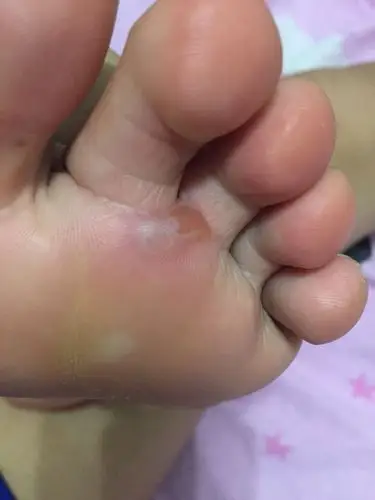 我的脚起泡了 该怎么办