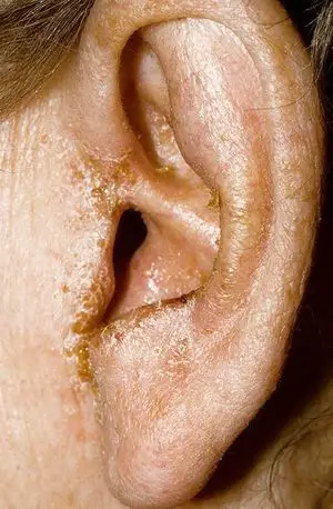 耳朵反复瘙痒怎么办?