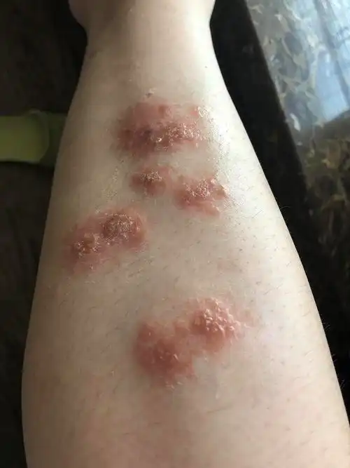 关于湿疹的治疗和后期养护