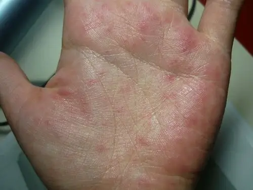 男性一期梅毒图片37