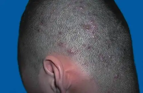 毛囊炎_症状表现_治疗方式 - 好大夫在线