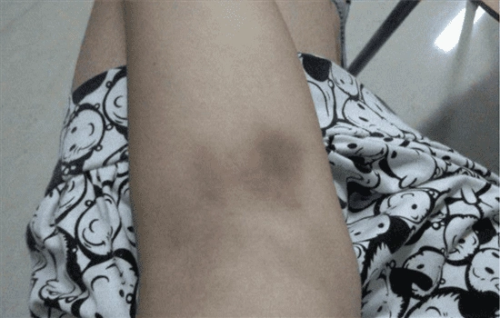 抽脂后遗症图片