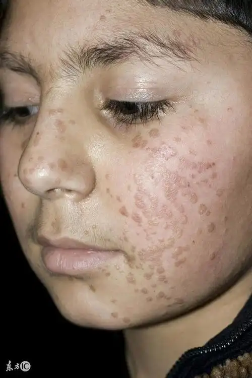 那么,扁平疣的症状有哪些?