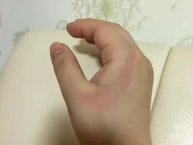 上次工作时不慎被130多度的消毒锅内壁烫伤了虎口部,冷手冲洗后用冰块