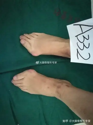 有了大脚骨怎么办1个小时解决问题自信人生开启新篇章