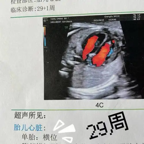 横位,(用b超医生的话说就是:没见过这么撇的胎位)本来已经做好剖腹产