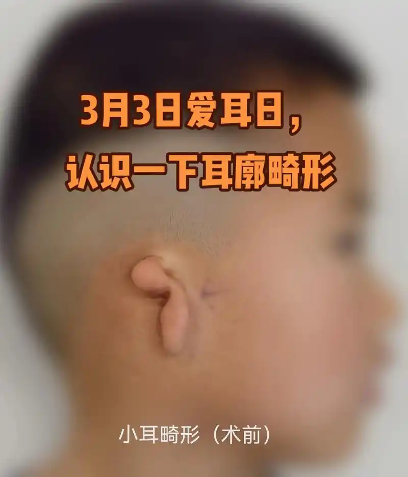 3月3日,全国爱耳日, 关注耳廓畸形,重拾容颜自信#医学科普 - 抖音