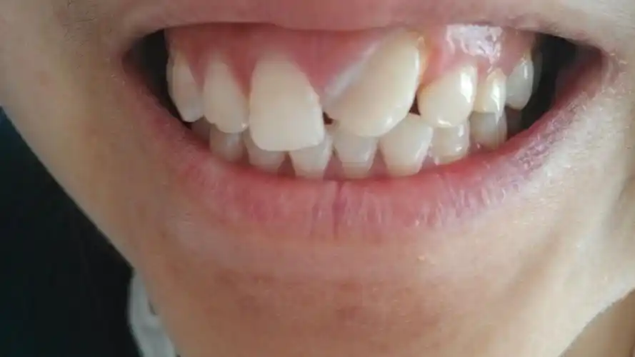 左侧门牙长歪了.