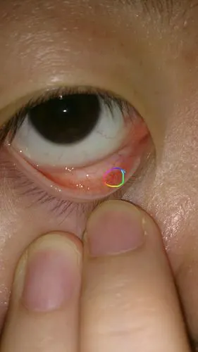 眼睛 眼皮 针尖 大小 疙瘩 搜索资料 本地图片