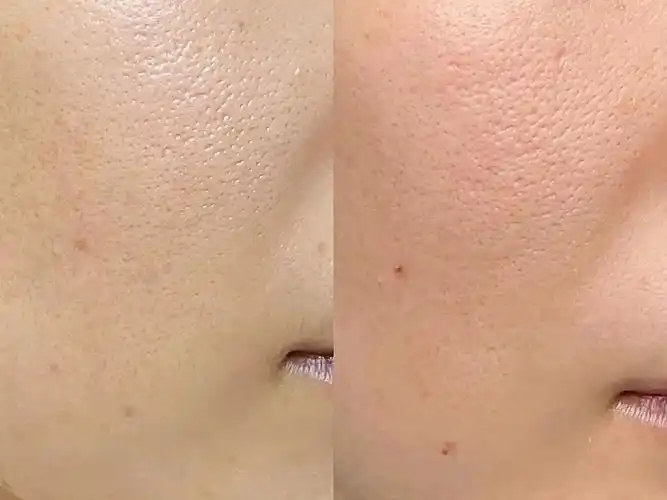 我原先皮肤干燥敏感毛孔粗大爱长痘,皮肤粗糙,越化妆_圈子-新氧美容