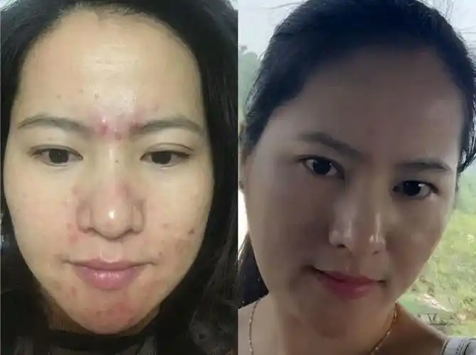 莱芙蔻"抗衰老生命密码护肤品祛斑祛痘去褶皱"产品使用前后惊人对比图