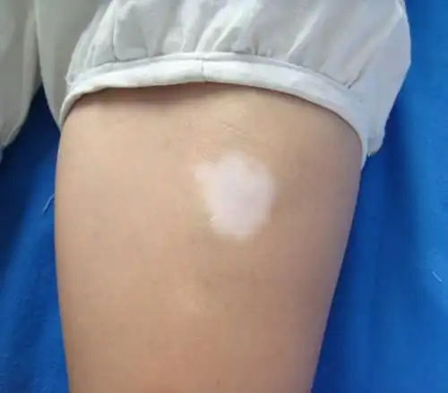 轻度白癜风图片_白斑