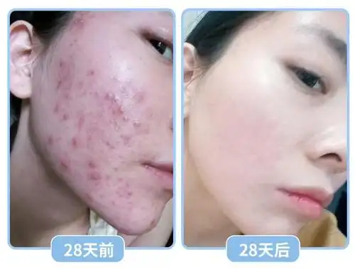 "痘痘隔天就消了"肌肤问题:熬夜痘 青春痘印 敏感肌@刘莹莹 25岁▼▼