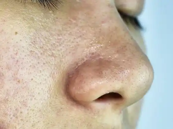 去黑头你要做本色肤雕细胞美疗宇彤护肤宇彤分层抗衰