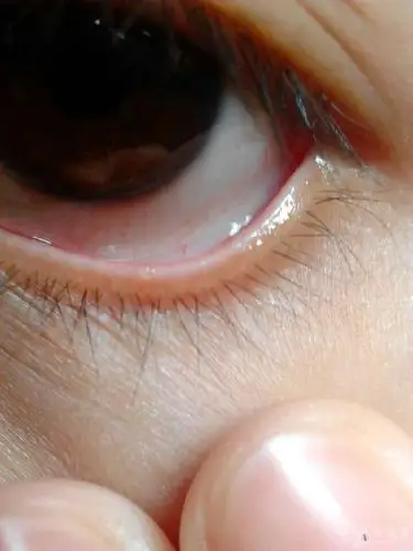 请各位帮我看看下眼睑起的小泡什么