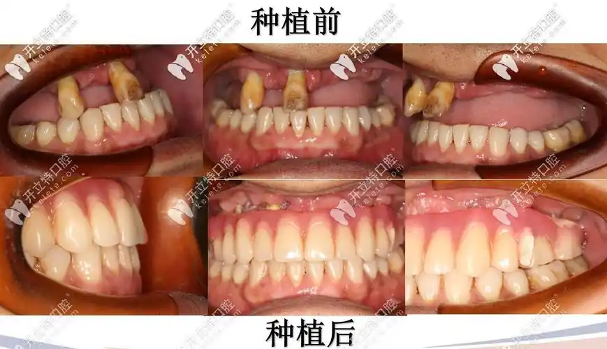 45岁就做德国icx上半口种植牙价格和恢复效果真的都不后悔