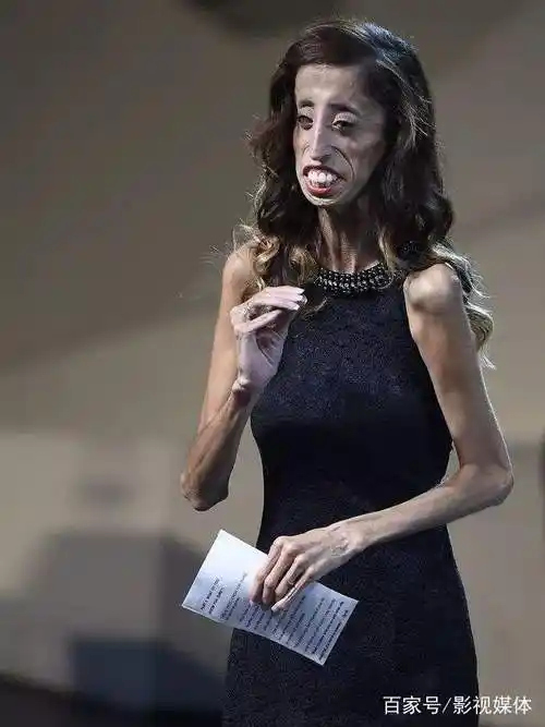 世界上最瘦的女人,身高1.57米,全身上下皮包骨