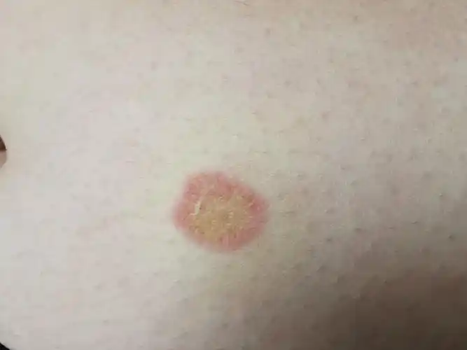 典型体癣一例伴有高清图片 - 好大夫在线