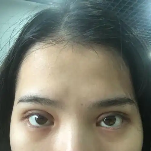 双眼皮做的是平行款的7mm,是不是太宽了?