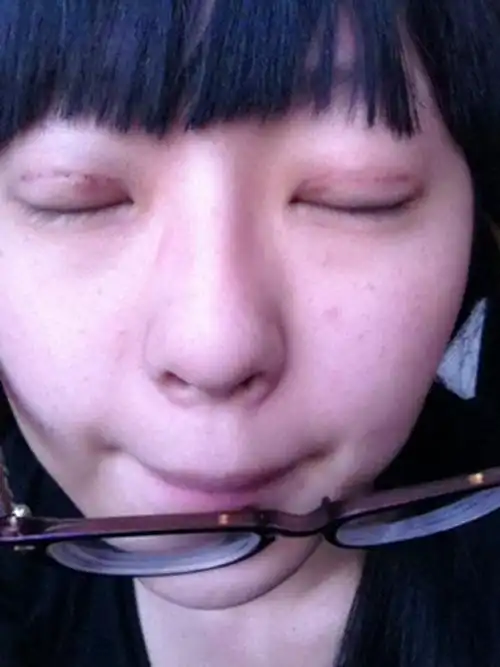 埋线双眼皮结节图片