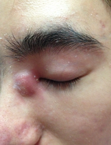 眼角长了个疙瘩图片 (42)