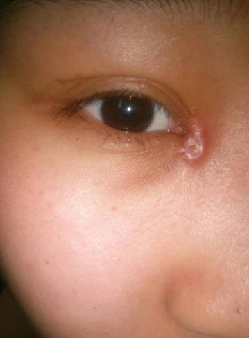 眼角长了个疙瘩图片 (16)_有来医生