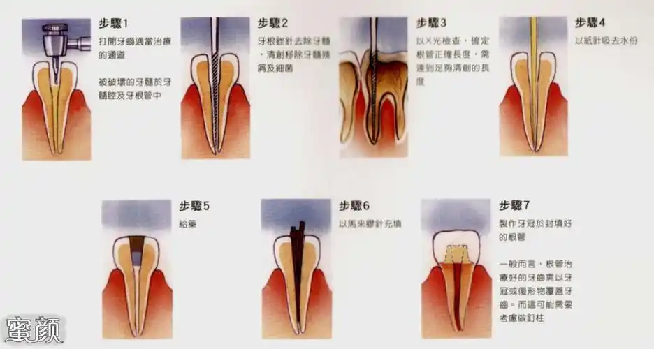 在湿润状态下测量根管长度,是一种非常方便的拔牙治疗仪器.