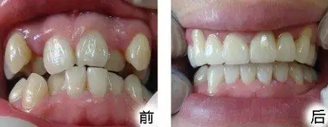 虎牙矫正前后对比图