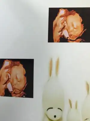 四维彩超的样子是这样子.生下来不是很丑嘛.额头像爸爸好长哦