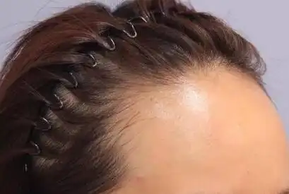 发际线种植 让你从此摆脱发际线后移烦恼