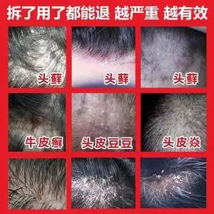 lucovitaal医药海外旗舰店天猫治疗牛皮癣藓头皮银屑病洗发水湿疹