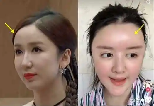 自体脂肪填充额头效果怎么样?会不会变成寿星公?