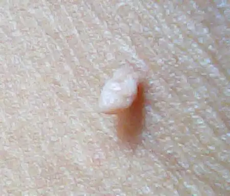 皮肤上长的小肉疙瘩是什么