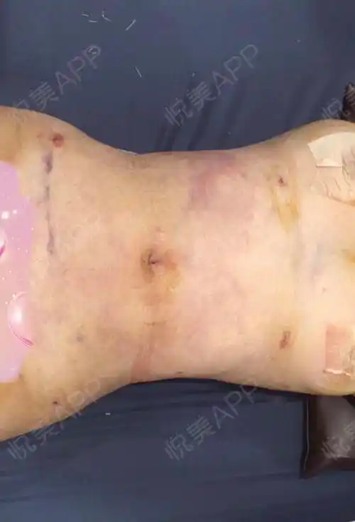 吸脂瘦腰腹手术当天_吸脂手术当天_瘦腰腹手术当天