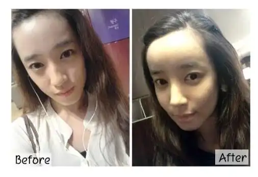 秀晶的长脸变短整形后记