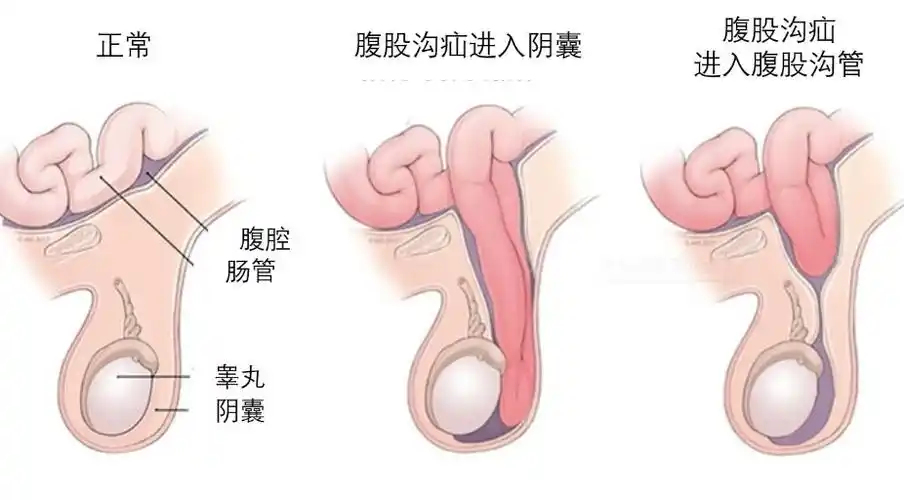 睾丸疝气图片 (7)
