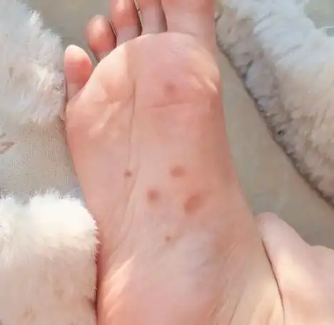 一个方法轻松解决脚气!止痒效果杠杠滴!