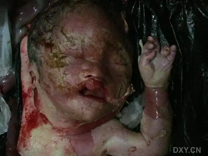 【共享】中孕胎儿双唇裂(引产证实)