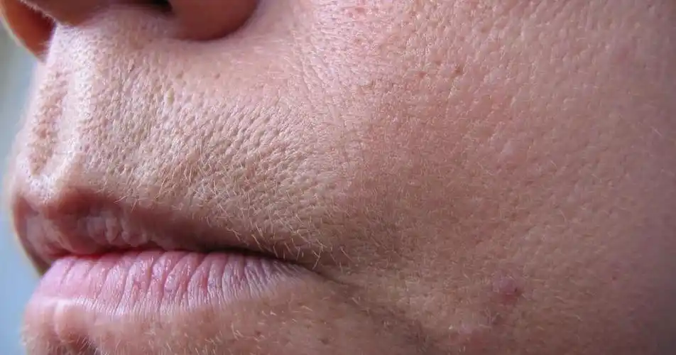 很多人以为毛孔粗大只和油有关系,所以频繁使用一些酒精含量高的或者