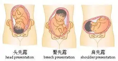 两纵轴平行者称为纵产式,如头位与臀位;两纵轴垂直者称为横产式;如为