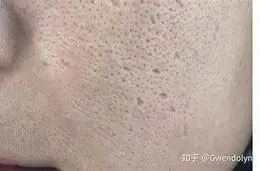 出油型毛孔粗大拯救计划##夏日护肤大作战##控油秘诀##收缩毛孔